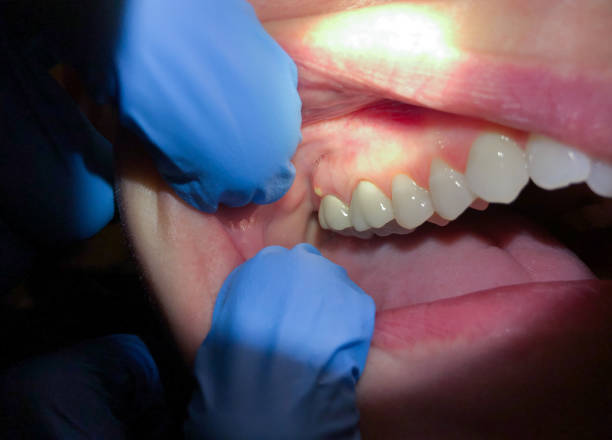 Best Dentist for Tooth Abscess  in West Middlesex, PA